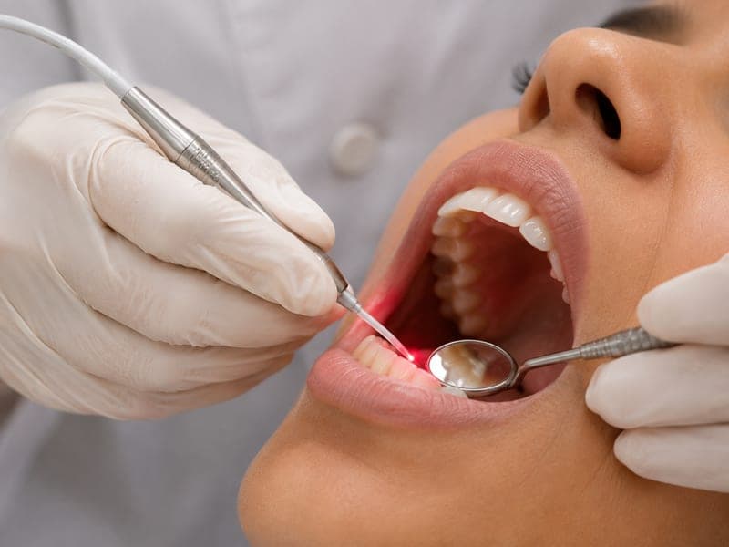 Laser Tooth Filling at DentoCare, Sonipat