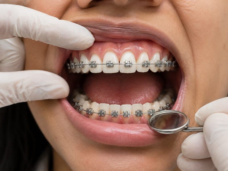 Orthodontic Treatment at DentoCare, Sonipat